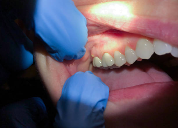 Best Broken or Chipped Tooth Repair in Burr Ridge, IL