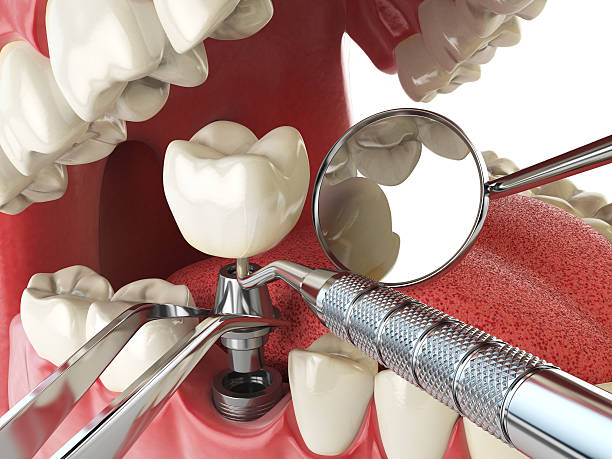 Best Emergency Denture Repair in Burr Ridge, IL
