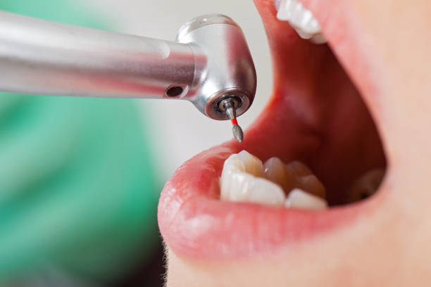 Best Emergency Root Canal Therapy in Burr Ridge, IL